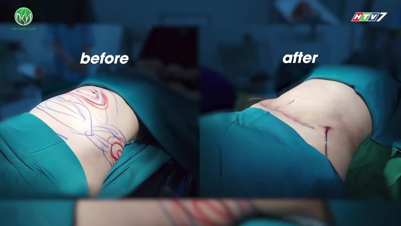 HÚT MỠ VÀ NHỮNG LƯU Ý QUAN TRỌNG