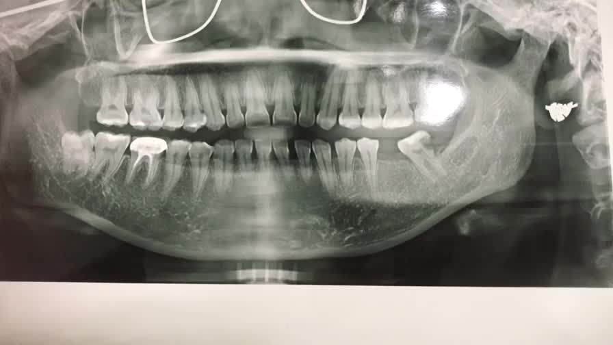 Ca cấy ghép chân răng nhân tạo implant vị trí số 36, 37 cho khách hàng tại Nha Khoa Thùy Anh.
