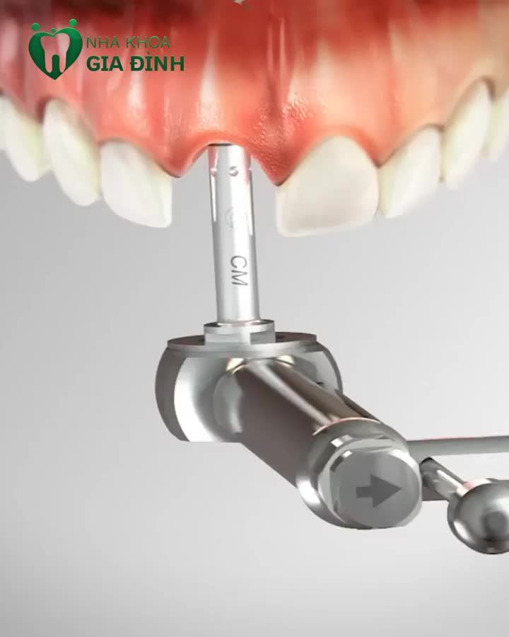 CẤY GHÉP IMPLANT CÔNG NGHỆ CAO KHÔNG ĐAU, TÍCH HỢP NHANH