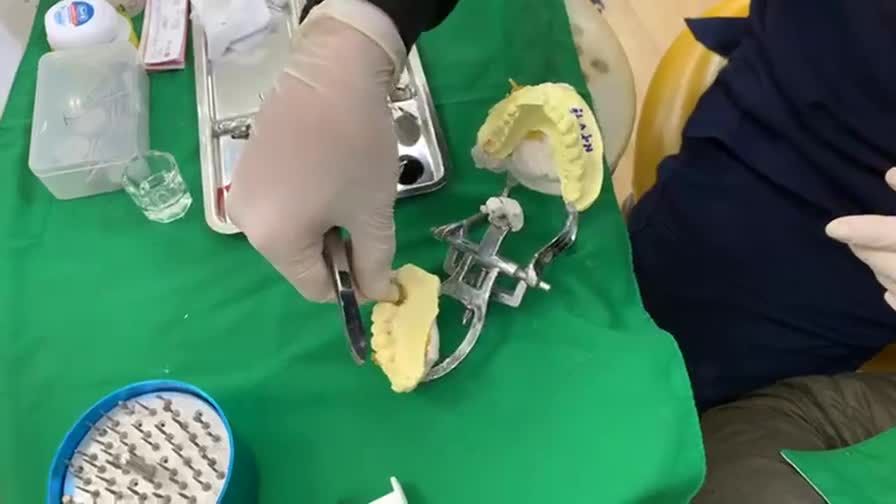 Lắp răng Implant khôi phục lại răng 27 bị mất cho bác khách hàng tại Nha Khoa Thuỳ Anh.