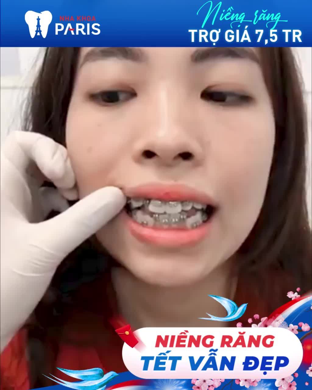 23 SUẤT NIỀNG RĂNG TRƯỚC TẾT