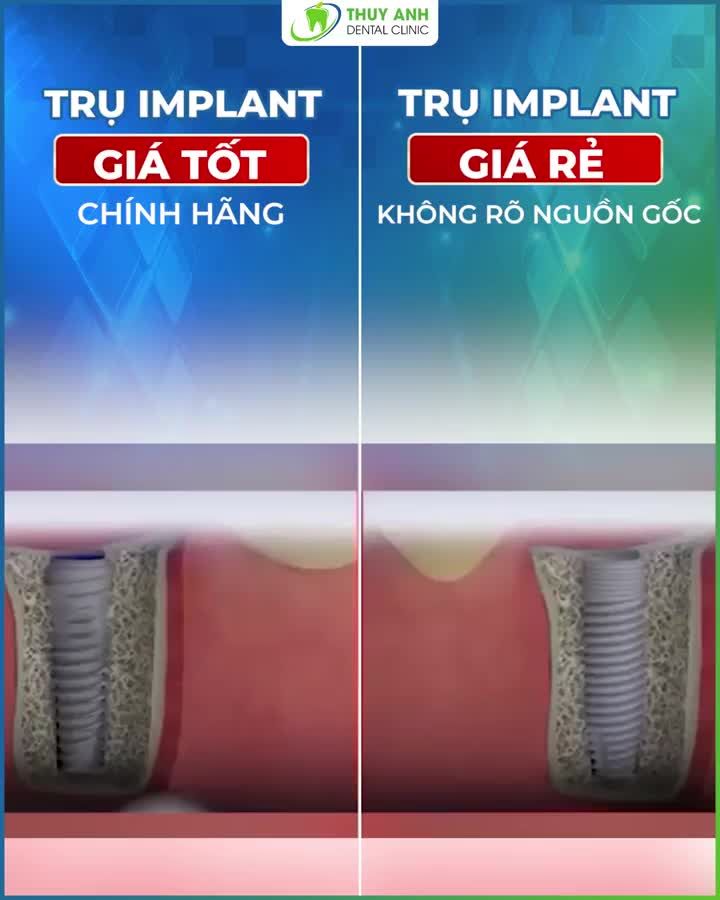 TRỒNG RĂNG IMPLANT BẠN MUỐN ĐẮT MÀ BỀN HAY RẺ MÀ NHANH HỎNG