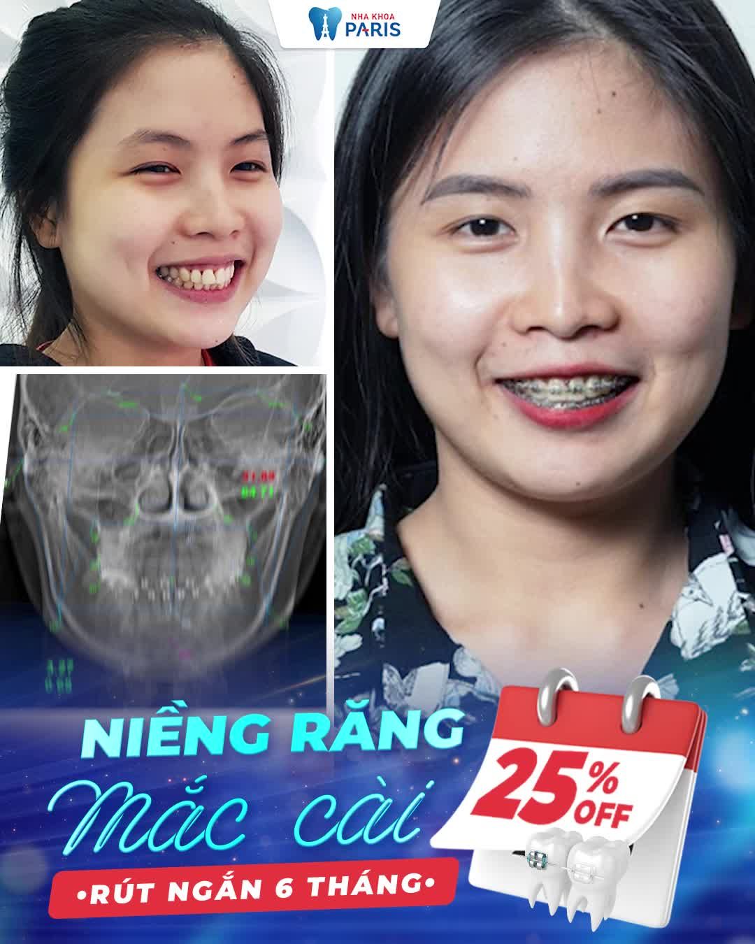 Niềng Răng Trước Tết