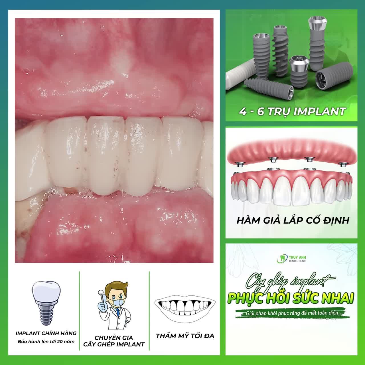 TRỒNG RĂNG TOÀN HÀM - RĂNG CHẮC KHỎE - THẨM MỸ TỐI ĐA