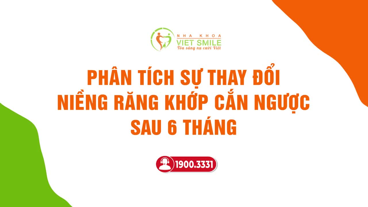 THAY ĐỔI RÕ RỆT SAU 6 THÁNG NIỀNG RĂNG MÓM
