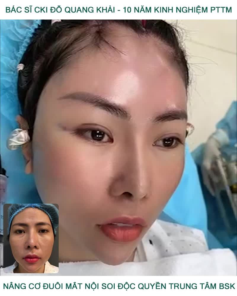 DỊCH VỤ NÂNG CƠ ĐUÔI MẮT ĐỘC QUYỀN TRUNG TÂM BS Đỗ Quang Khải