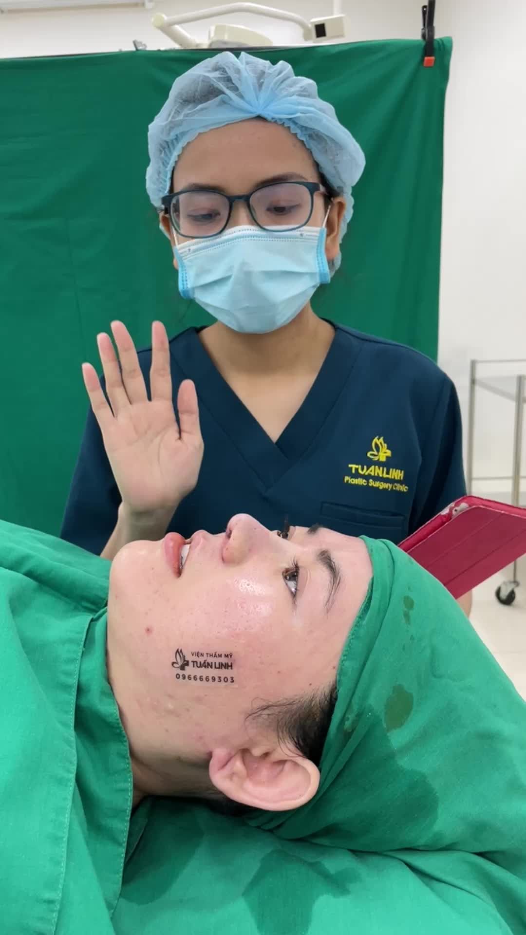 Ca nâng mũi siêu cấu trúc sụn sugrifom cho bạn gái mũi rất tẹt