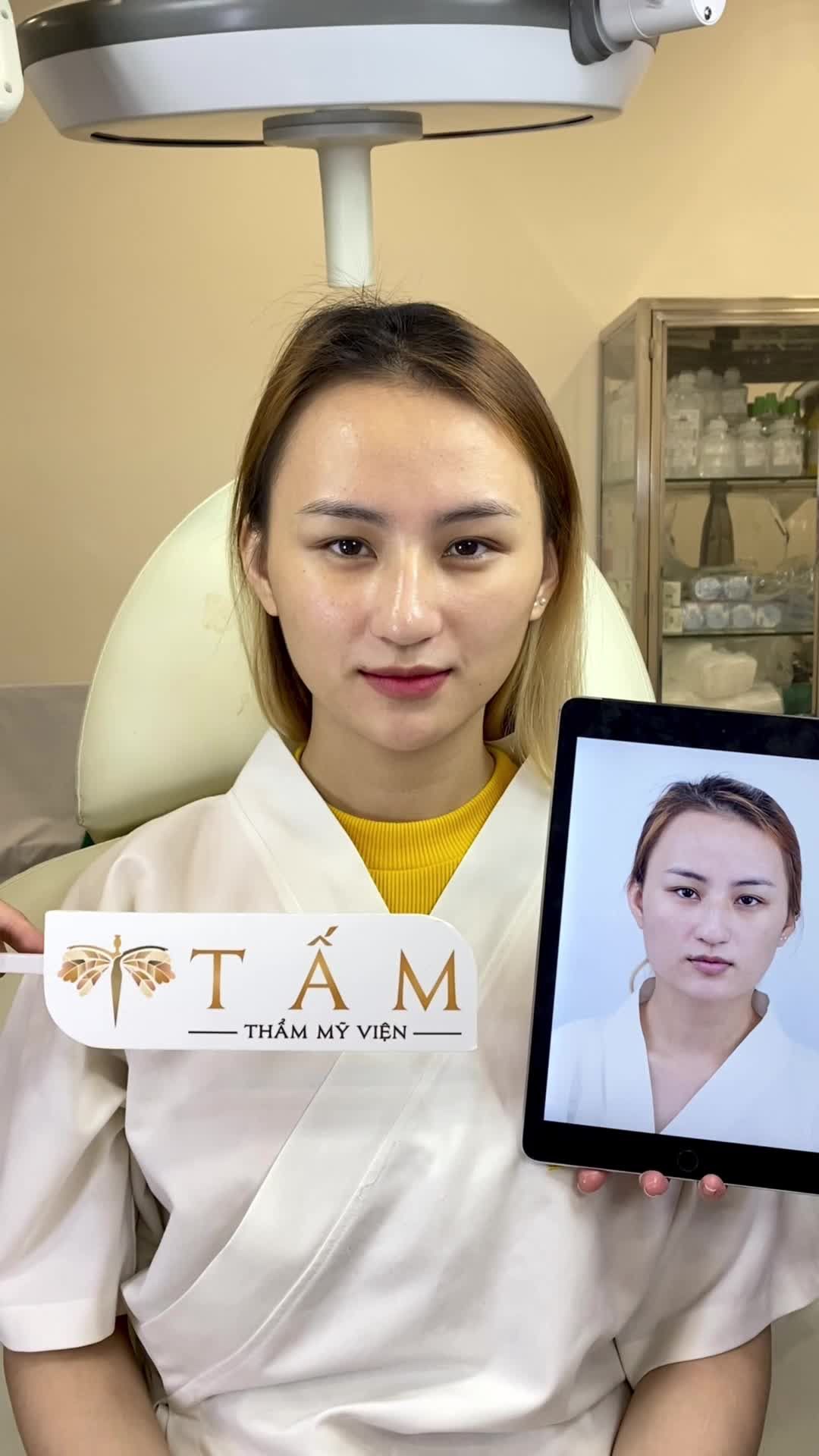 Chị khách quay lại tái khám sau 2 tháng sử dụng dịch vụ Vline Perfect tại Thẩm mỹ viện Tấm.