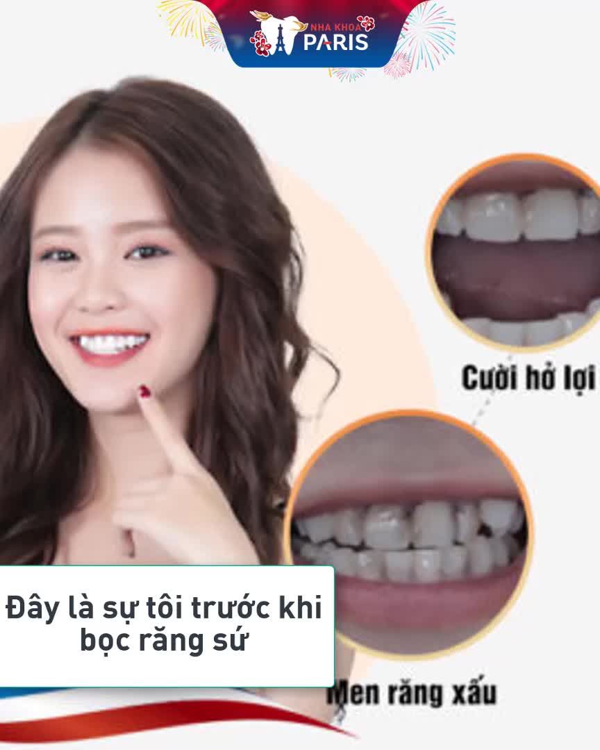 5 Lý Do Nên Bọc Răng Sứ