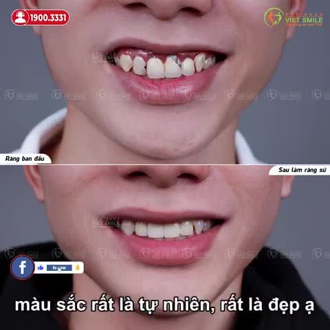 ĐIỀU TRỊ VIÊM LỢI, BỌC SỨ MỚI HOÀN THIỆN NỤ CƯỜI