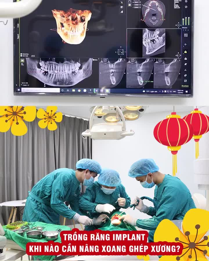 Trồng răng Implant khi nào cần nâng xoang ghép xương?