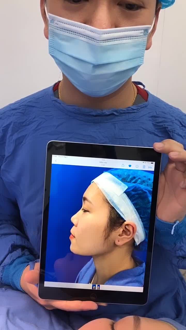 Hé lộ trực tiếp kết quả nâng mũi 6D Surgiform ngay sau phẫu thuật