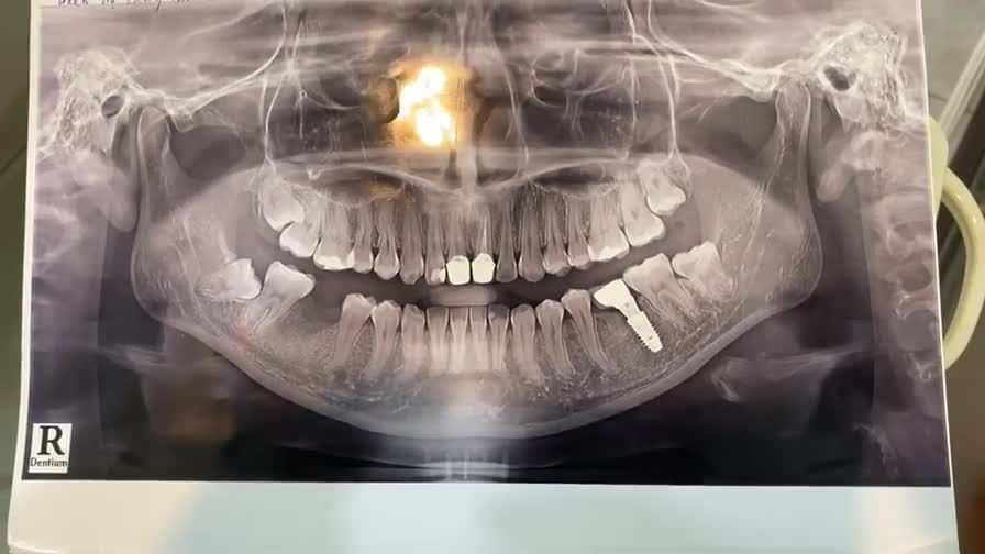 Ca lắp răng sứ trên implant vị trí răng số 46 cho khách hàng