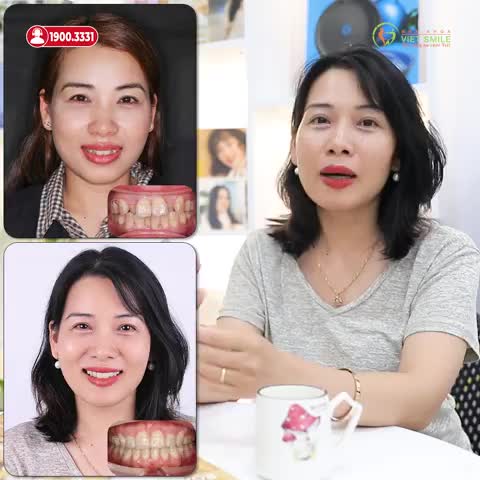 U30, 40 CÓ NIỀNG RĂNG ĐƯỢC KHÔNG?