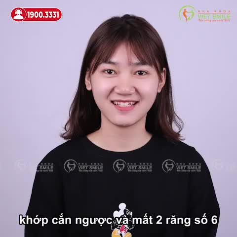 KẾT QUẢ NIỀNG RĂNG MÓM, KÉO RĂNG 7,8 THAY THẾ RĂNG 6 VIÊM CUỐNG