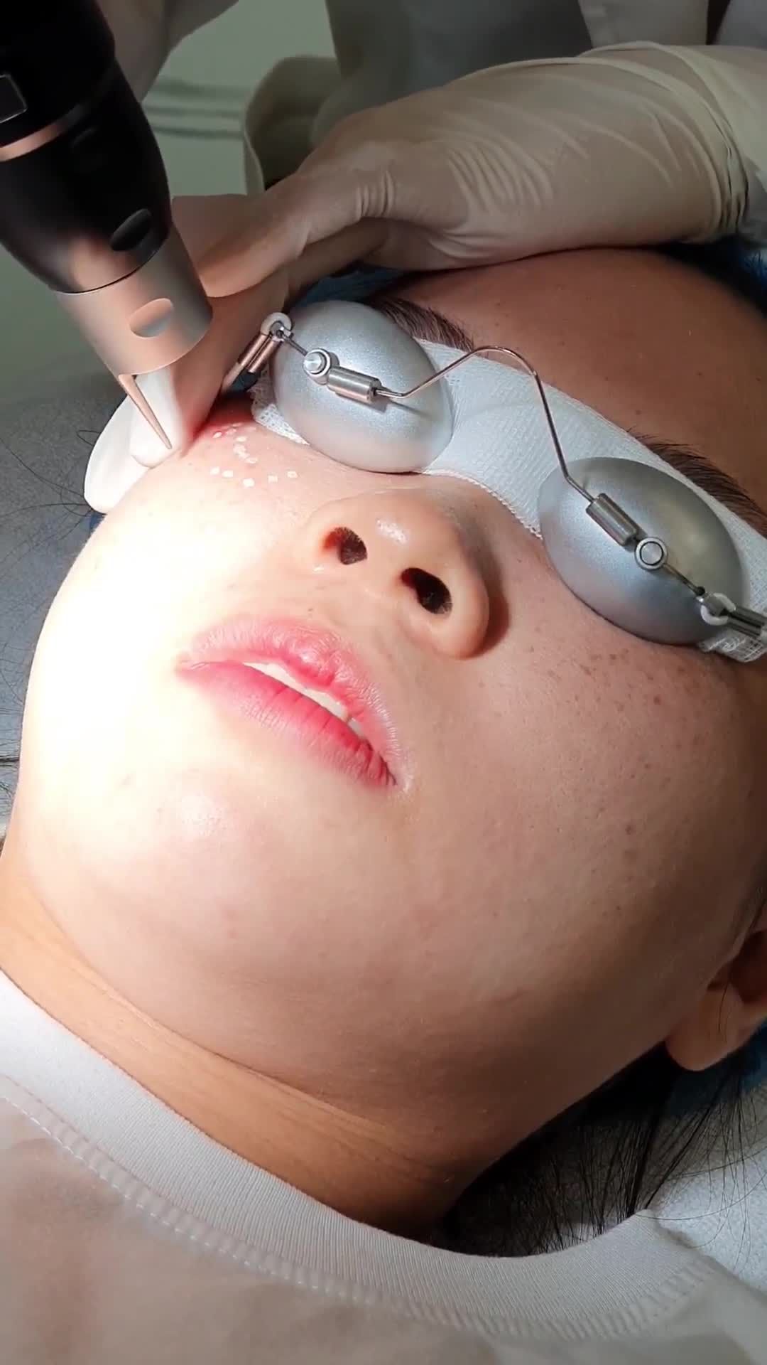 Cận cảnh bông tuyết ngay sau Trị tàn nhang với Laser Picosure
