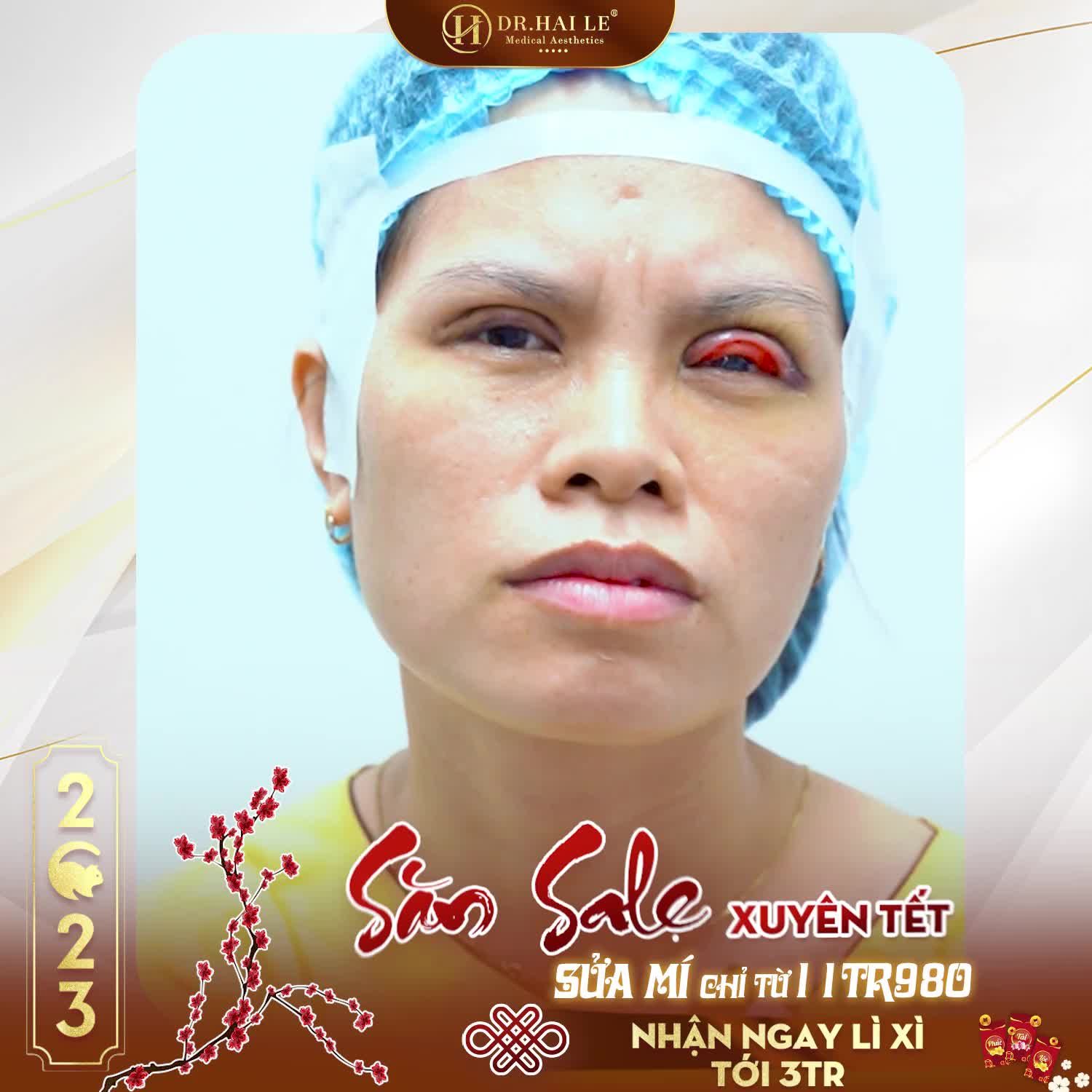 "Từ lúc làm mí hỏng, lúc nào cũng cộm ngứa, 7 ngày nay không ngủ được, đi đâu cũng không ai dám nhận sửa...."