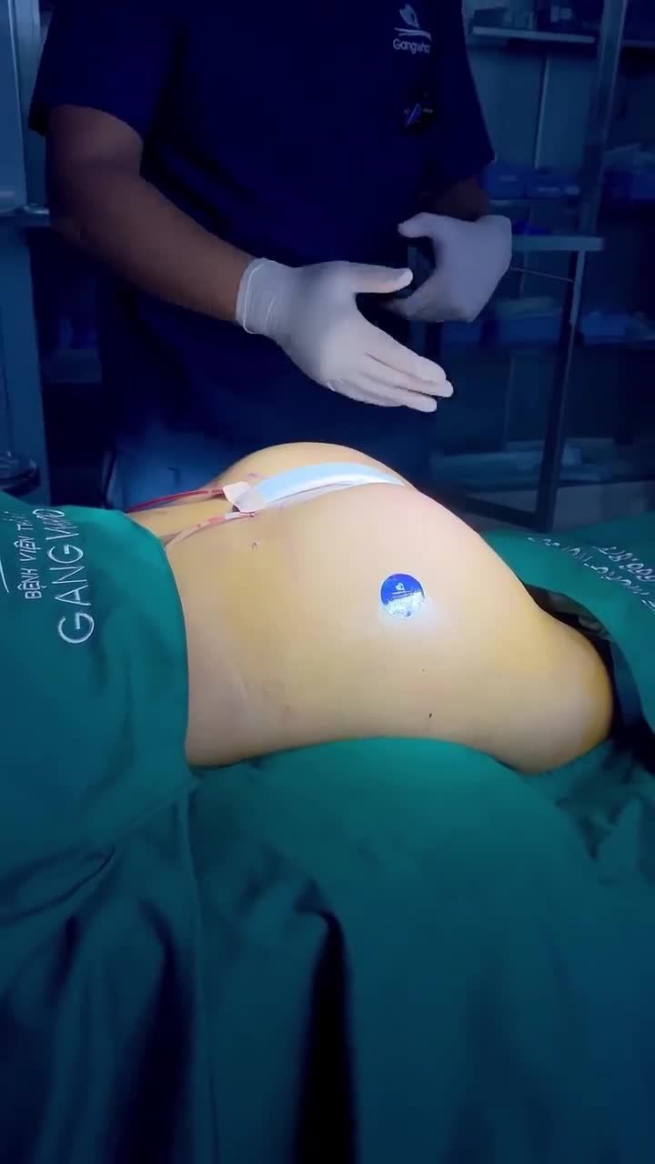 NÂNG MÔNG NỘI SOI - AN TOÀN - HẠN CHẾ XÂM LẤN - CHỈ VỚI 90 PHÚT ĐÃ CÓ NGAY MỘT DÁNG MÔNG HÌNH TRÁI TÁO CỰC MẨY