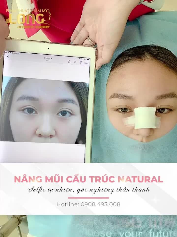 Có ai đang tò mò không biết dáng mũi sau khi nâng sẽ như thế nào không????