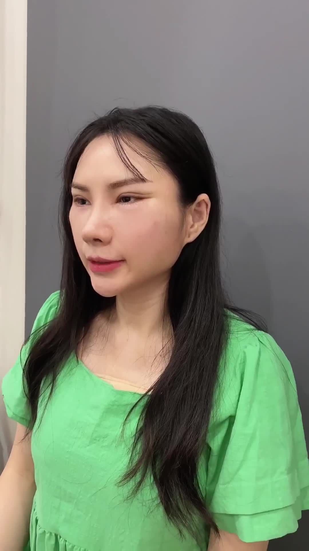 KHÁCH HÀNG THỰC HIỆN 3 DỊCH VỤ CỰC HOT TẠI TRUNG TÂM : NÂNG MŨI, CĂNG DA NỘI SOI, MỞ GÓC MẮT TRONG