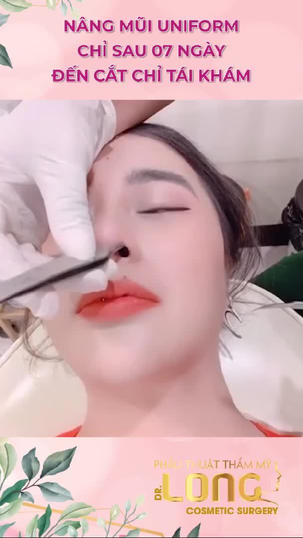 Dáng mũi sau 7 ngày của khách hàng.