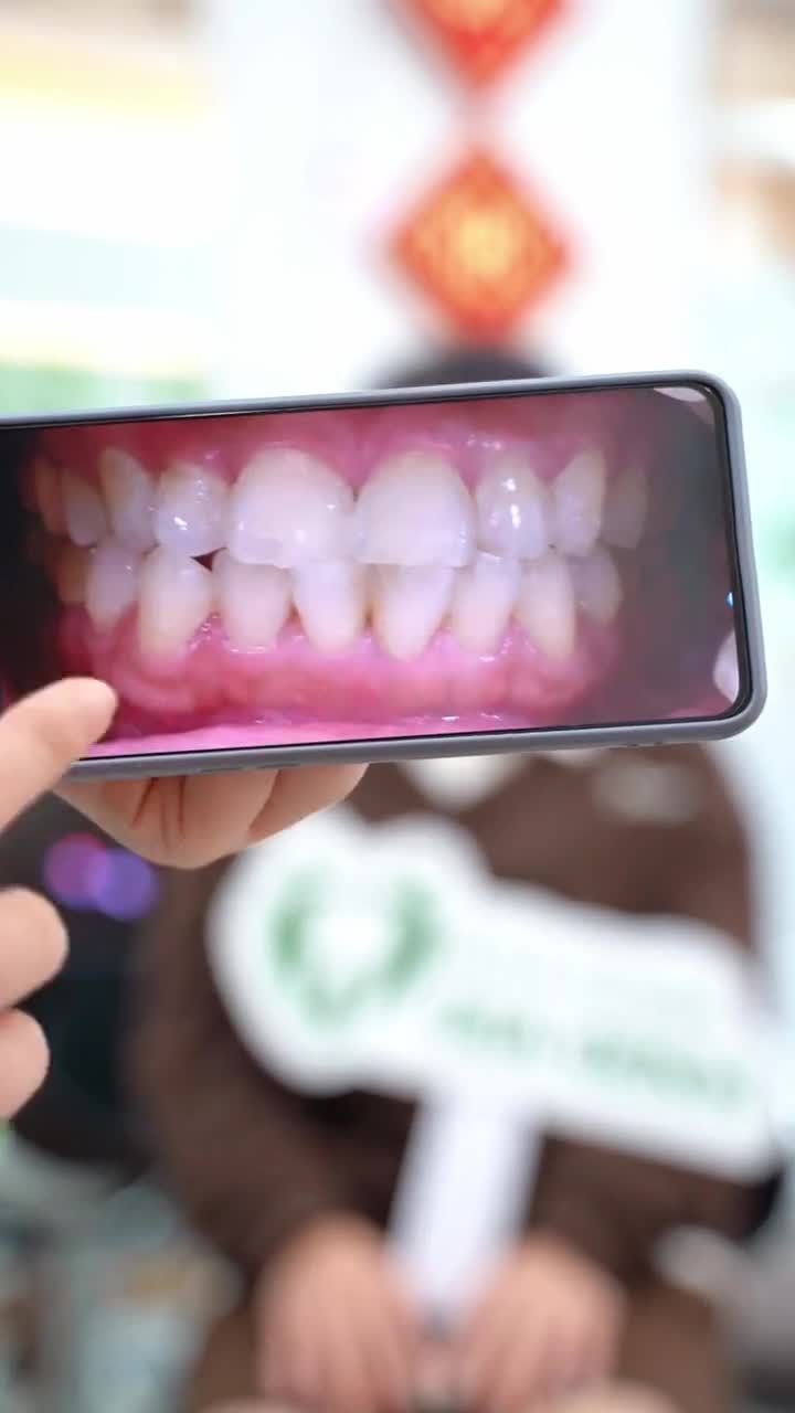NỮ KHÁCH HÀNG XINH ĐẸP THẨM MỸ 18 RĂNG SỨ ORODENT WHITEMATT