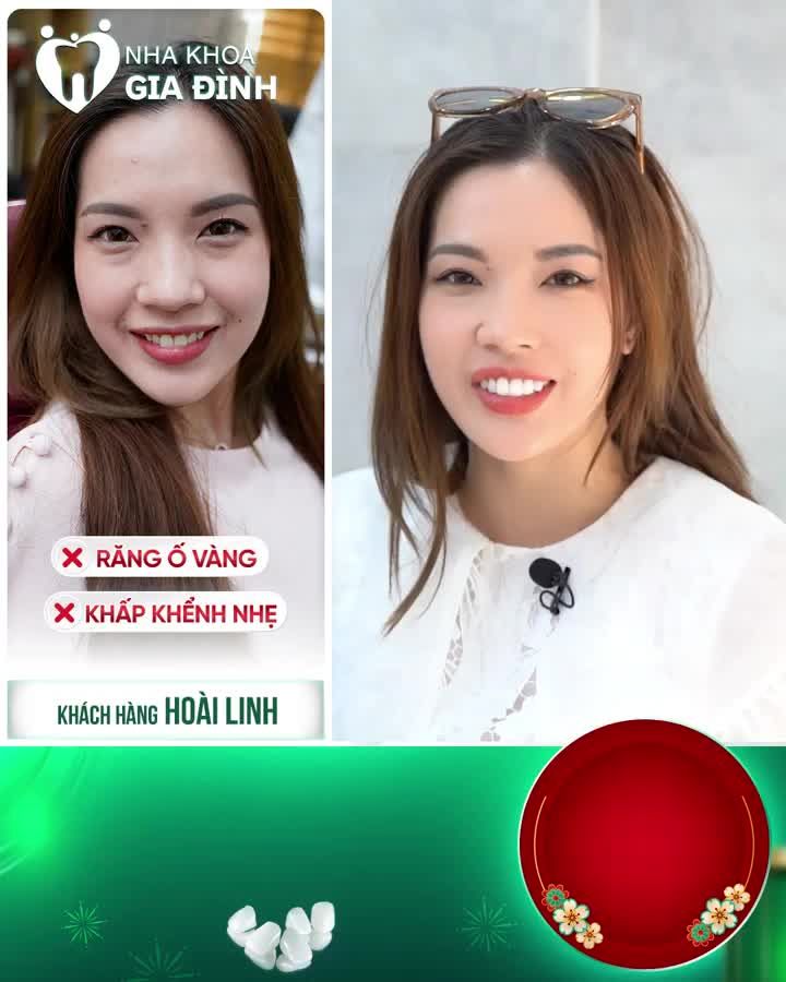 CHỈ 2 LẦN HẸN SỞ HỮU NGAY NỤ CƯỜI CUỐN HÚT