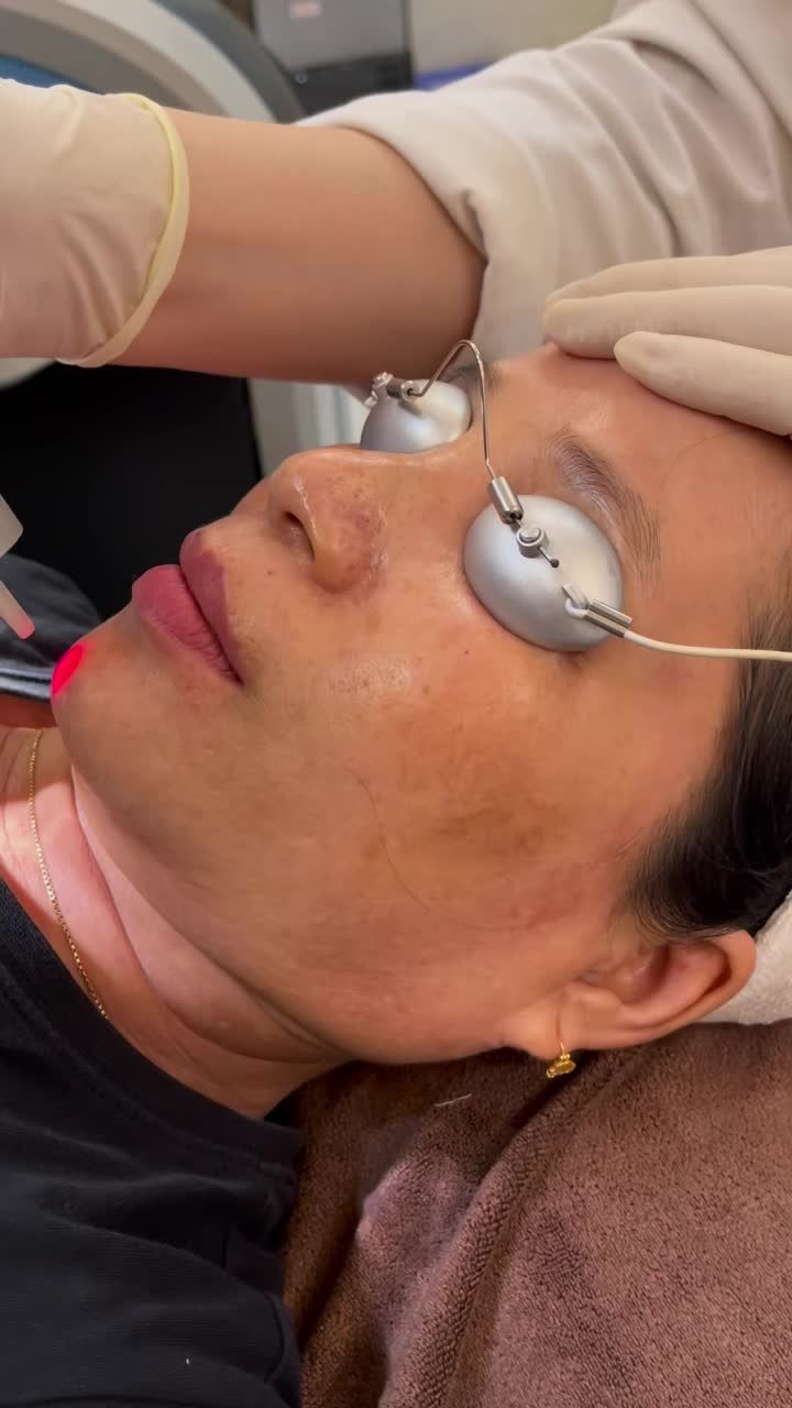 "Đột nhập" phòng Laser, xem cận cảnh Điều trị Nám bằng công nghệ cao Laser Picosure và xịt lạnh Zimmer.