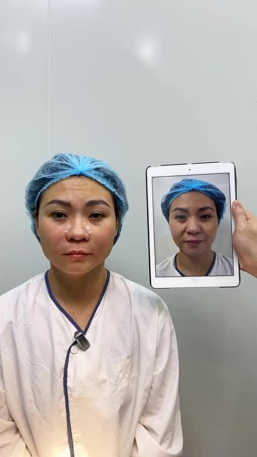 CẤY MỠ TỰ THÂN - "VŨ KHÍ TỐI TÂN" GIÚP HỒI XUÂN CHỈ SAU 1 LẦN