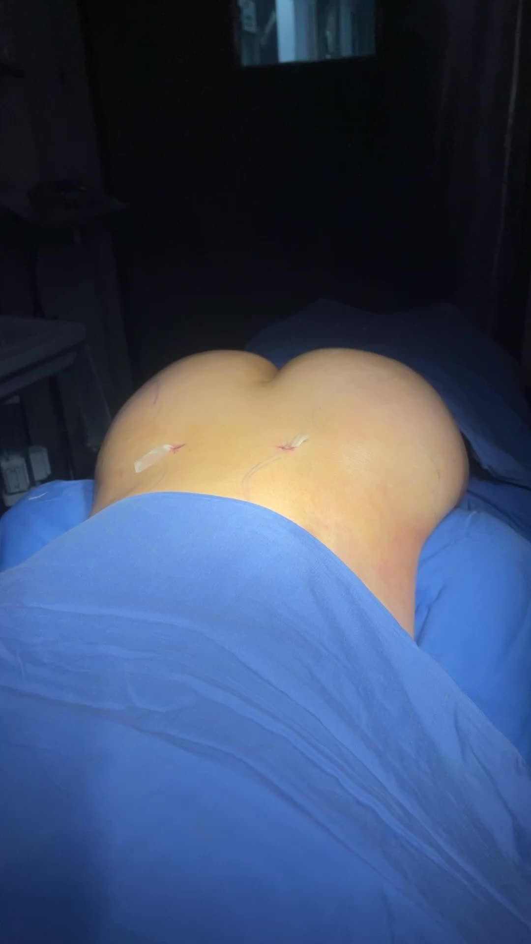 kết quả phẫu thuật cấy mỡ mông tại Kangnam