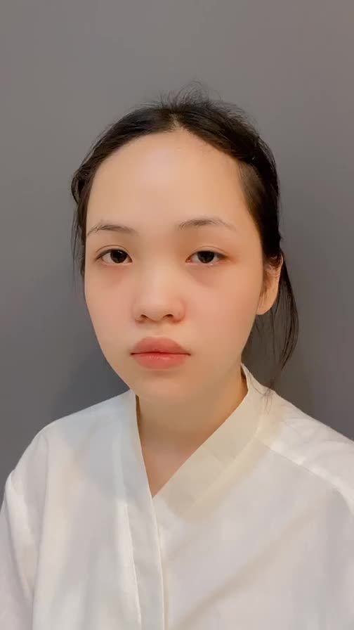 CA CHỈNH NHƯỢC CƠ NÂNG MI CHO KHÁCH HÀNG ĐẾN TỪ HOA KỲ