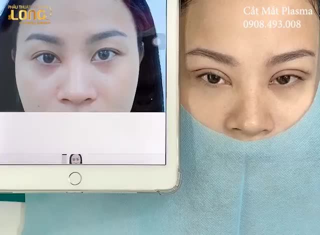 Khoe nhẹ thành phẩm của khách hàng sau màn cắt mí cả nhà ơi!!!!