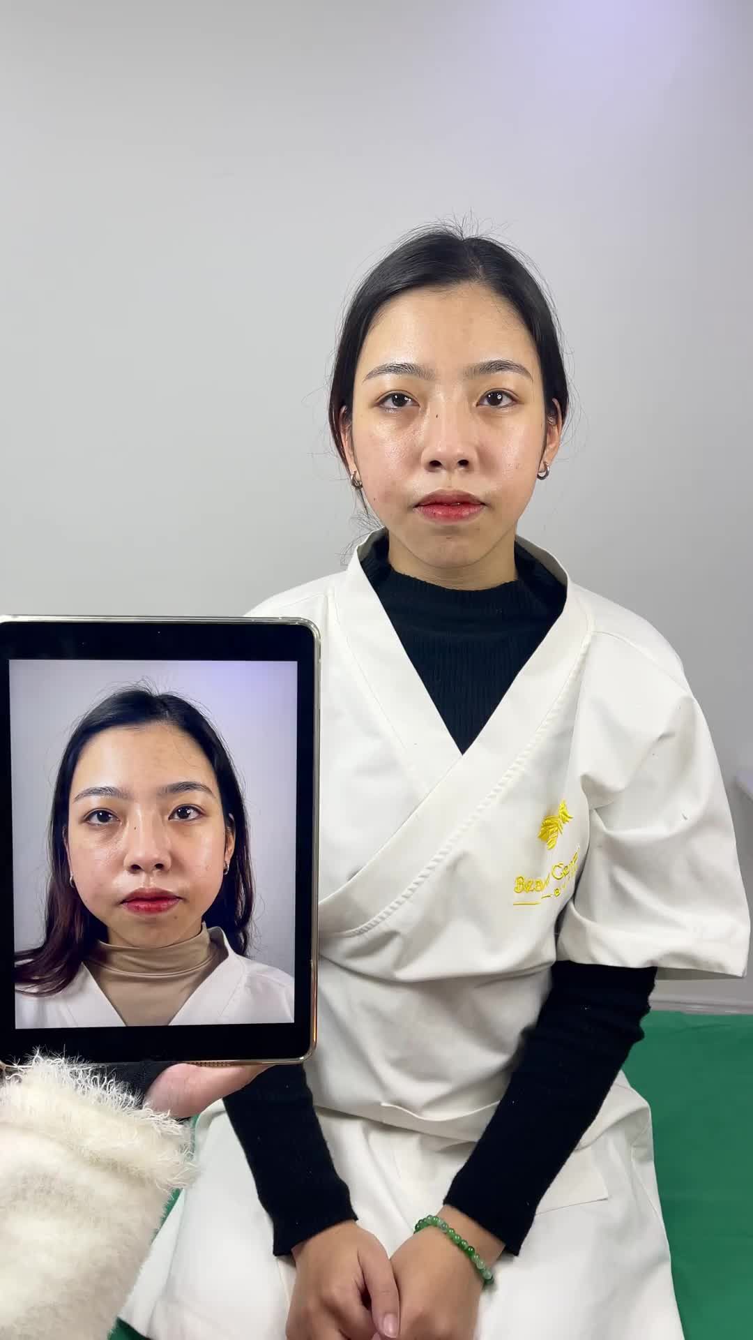 Ca Vline Perfect quay lại tái khám tại TMV Tấm