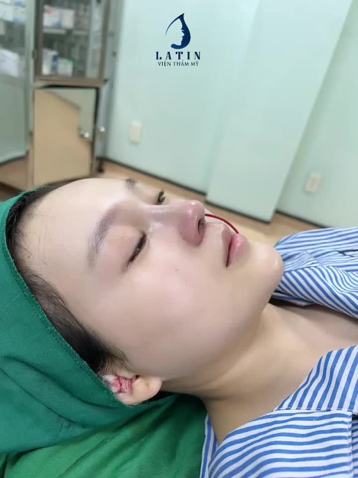 Mũi cấu trúc dáng tự nhiên cho em gái đến từ Tiền Giang