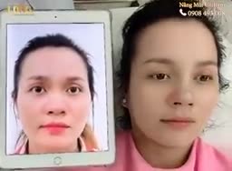 MUỐN MŨI ĐẸP TỰ NHIÊN NHƯ CHƯA TỪNG QUA PHẪU THUẬT