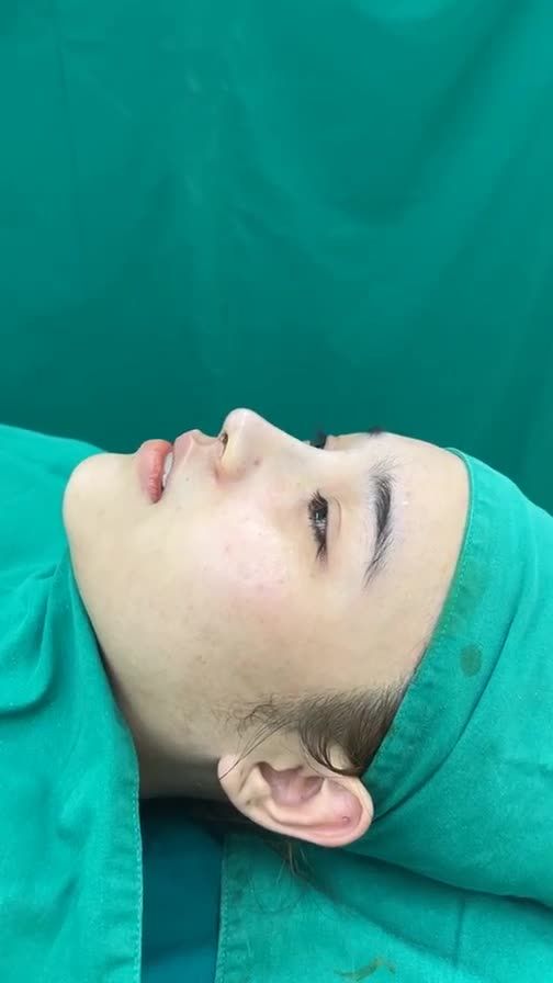Case mũi cấu trúc bọc megaderm đầu mũi vừa hoàn thành