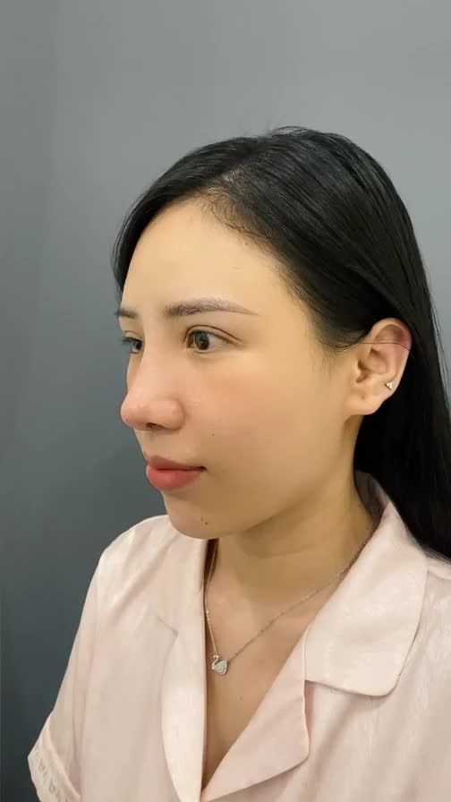 KHÁCH HÀNG CẮT MÍ TRÊN 1 NĂM, NÂNG MŨI SAU 3 NGÀY