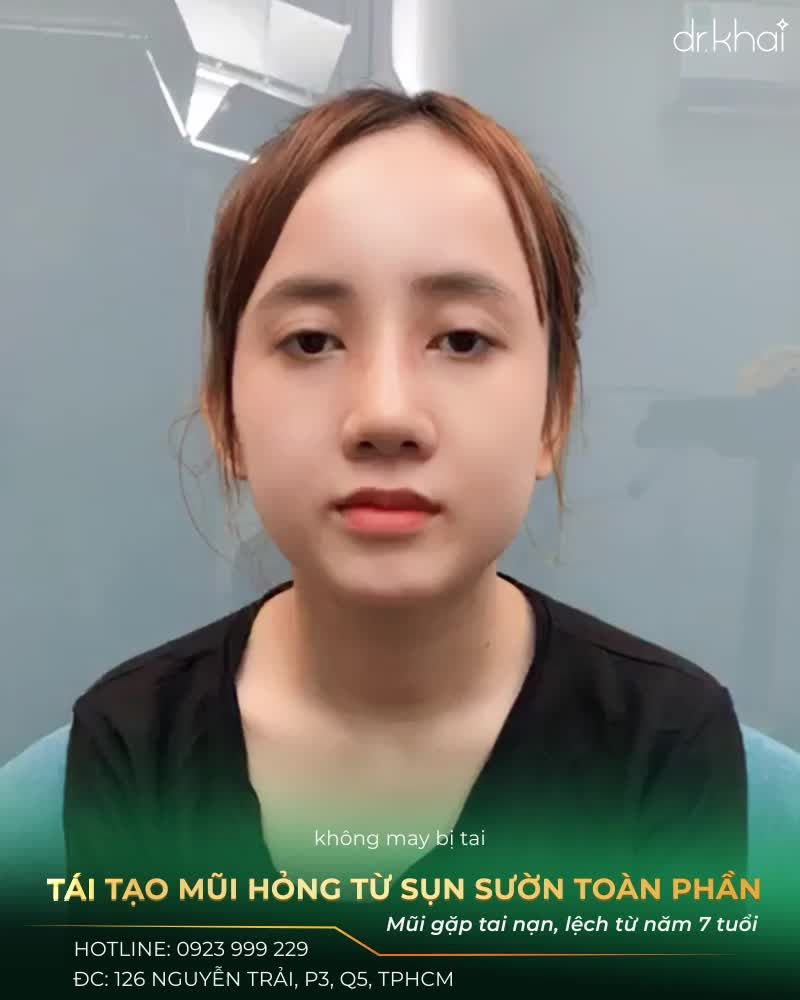 NÂNG MŨI SỤN SƯỜN - CA TÁI TẠO MŨI HỎNG TỪ NĂM 7 TUỔI
