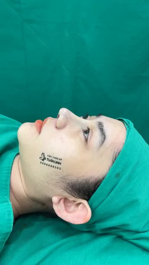 Case mũi cấu trúc vừa thực hiện xong