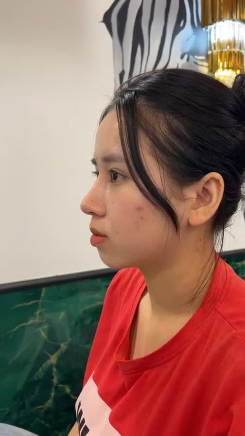 Case mũi cấu trúc tái khám sau 7 tháng
