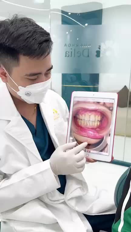 Cảm nhận sự khác biêt sau 1 năm thẩm mỹ 20 răng sứ Emax cao cấp