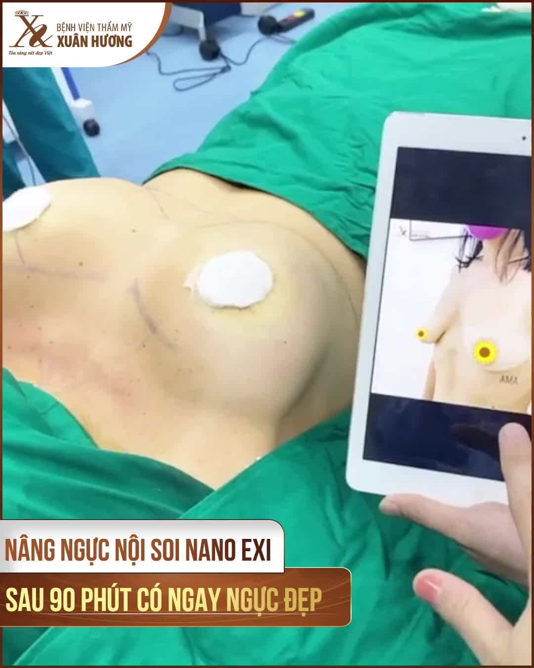 TUYẾN VÚ TEO, V1 BỊ SA TRỄ CẤP ĐỘ 2 VÀ KẾT QUẢ ĐƯỢC BÁC SĨ TẠI XUÂN HƯƠNG "HÔ BIẾN" SAU 60 PHÚT