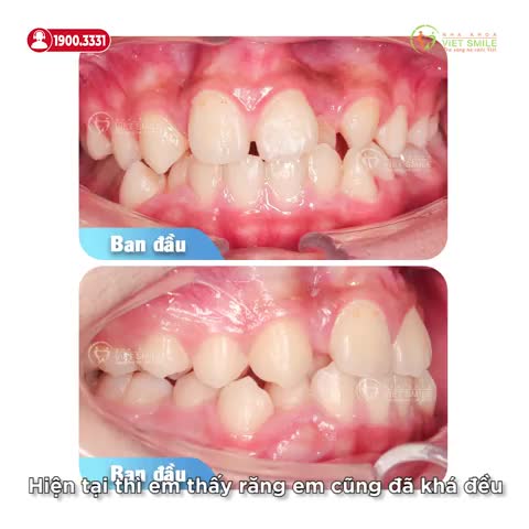 NIỀNG RĂNG KHẮC PHỤC KHẤP KHỂNH - RĂNG KHỎE ĐẸP, CƯỜI TỰ TIN