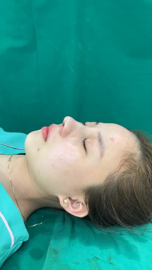 Case mũi cấu trúc vừa hoàn thành