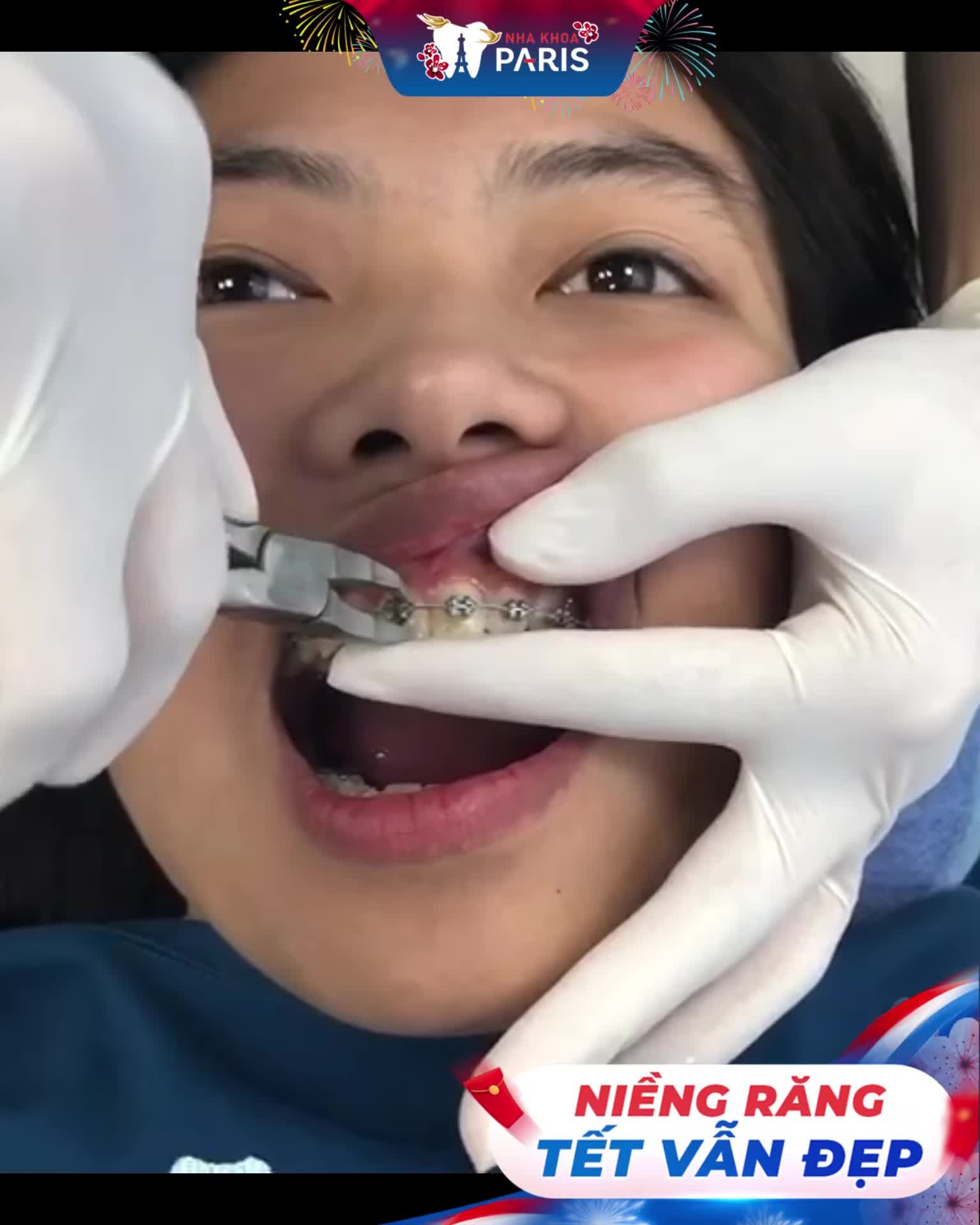 Mẹ “Ép” đi niềng răng và thành quả sau 2 năm