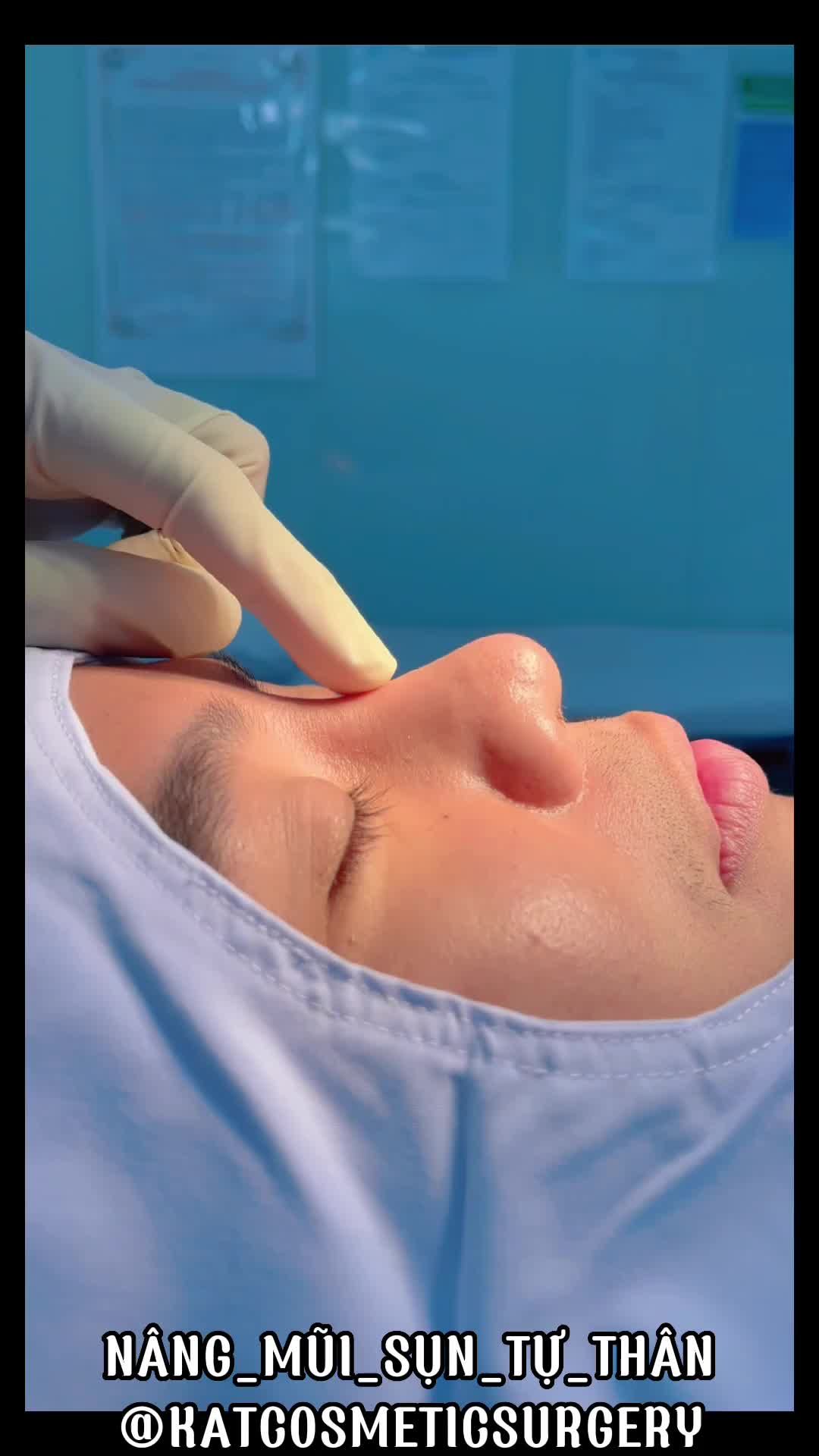 Một dáng mũi hoàn toàn phù hợp với bạn chỉ riêng bạn do kỹ thuật điêu khắc đến từ các bác sĩ của KAT