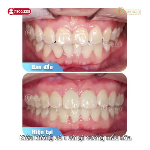 NIỀNG RĂNG LÀ QUYẾT ĐỊNH ĐÚNG ĐẮN NHẤT!?