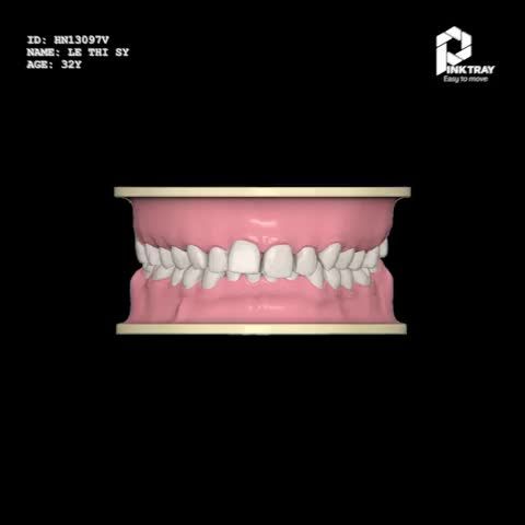 Niềng răng trong suốt PinkTray cải thiện khớp cắn sâu, biết trước kết quả chỉnh nha