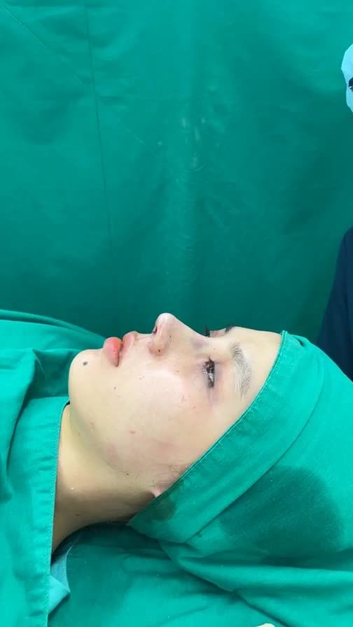 Case mũi cấu trúc sửa lại vừa hoàn thành