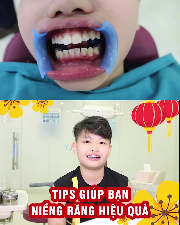 Tips giúp bạn niềng răng hiệu quả!